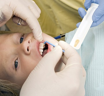 Child receiving dental sealant application