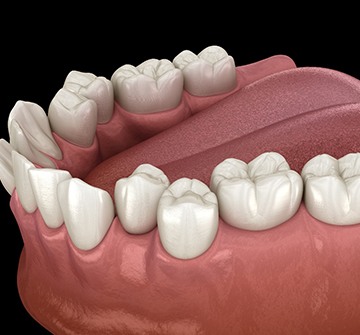 Illustration of crooked teeth