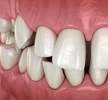 Illustration of gapped teeth