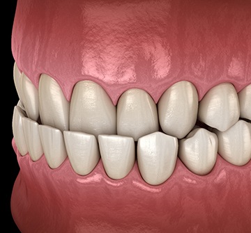 Illustration of an underbite