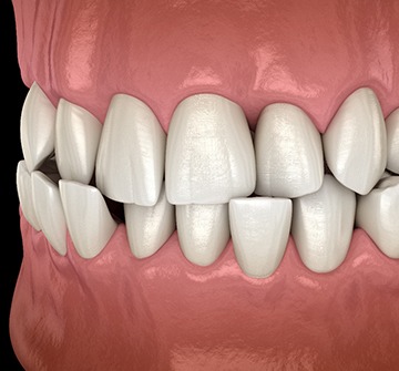 Illustration of a crossbite