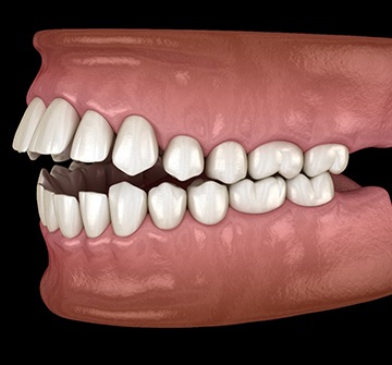 Illustration of an open bite
