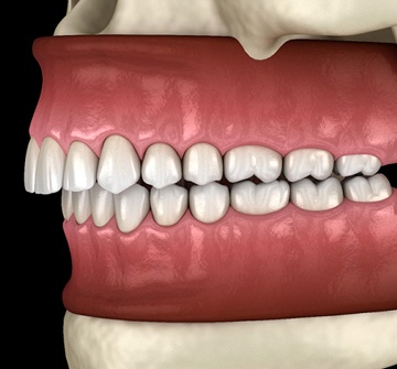 Image of an overbite