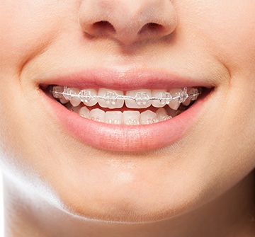 Closeup of smile with tooth-colored braces