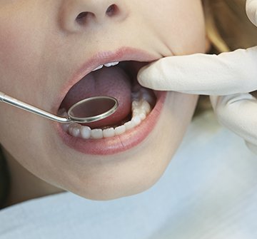 Closeup of child receiving dental exam