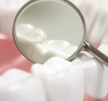 Closeup of teeth with dental sealants