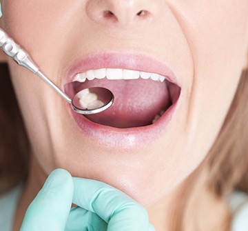 Closeup of patient during dental treatment