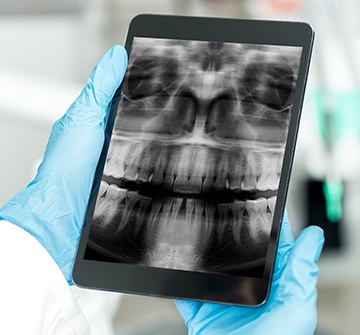 Digital dental x-rays on tablet computer